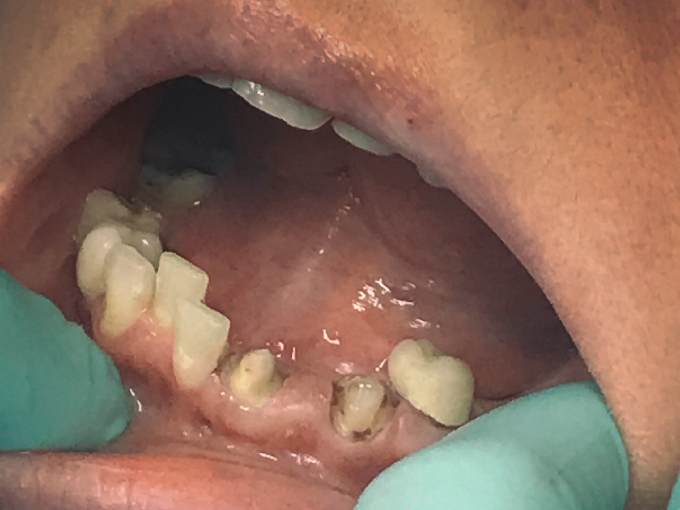 Fiser Family Dental Care CEREC Bridge Before