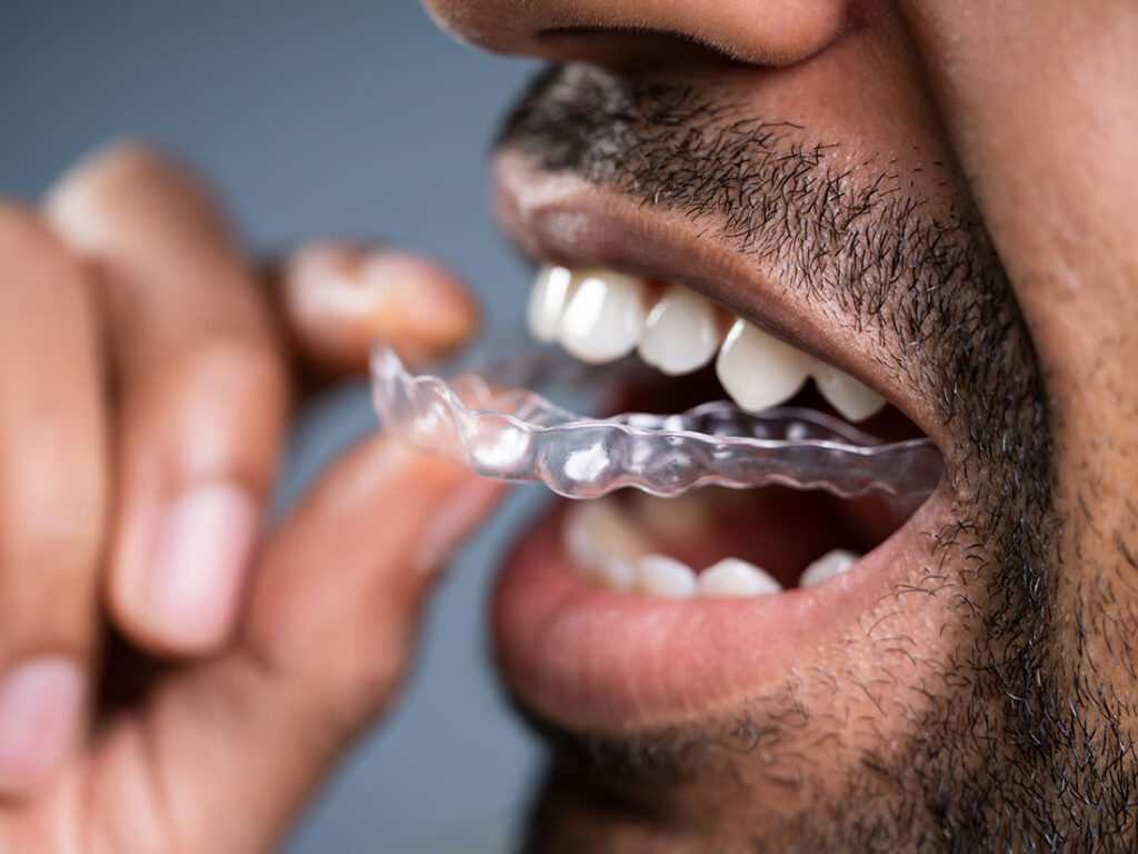 Clear Braces and Aligners at Fiser Family Dental