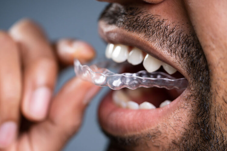 Clear Braces and Aligners at Fiser Family Dental