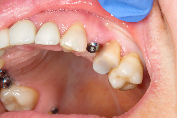 Dental Implants at Fiser Family Dental