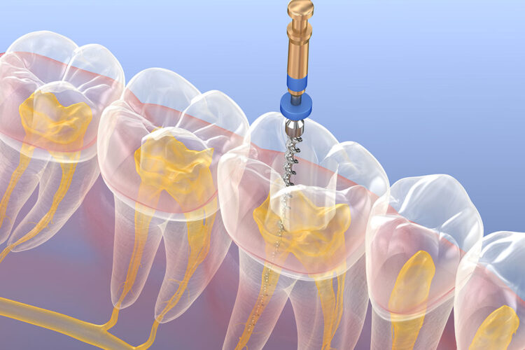 Endodontics / Root Canal Therapy at Fiser Family Dental
