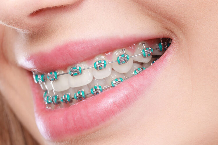 Orthodontics at Fiser Family Dental